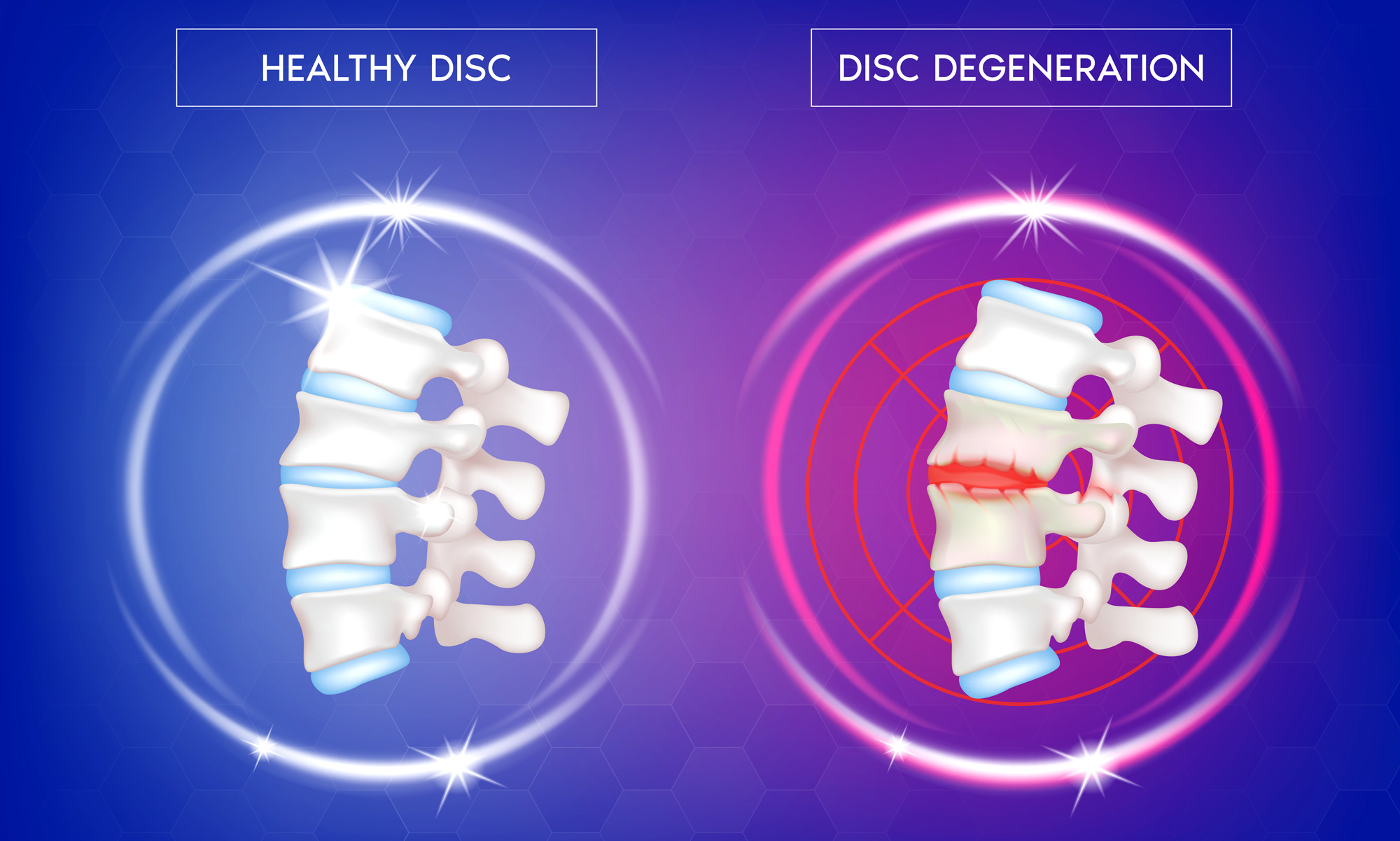 Disc Decompression